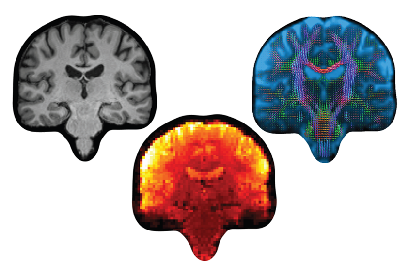 Dataset maps connectivity in 40,000 brains | Spectrum | Autism Research News