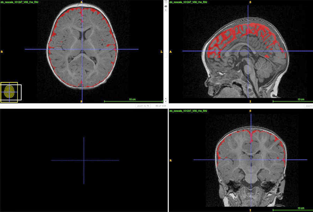 Is excess brain fluid an early marker of autism? | Spectrum | Autism Research News