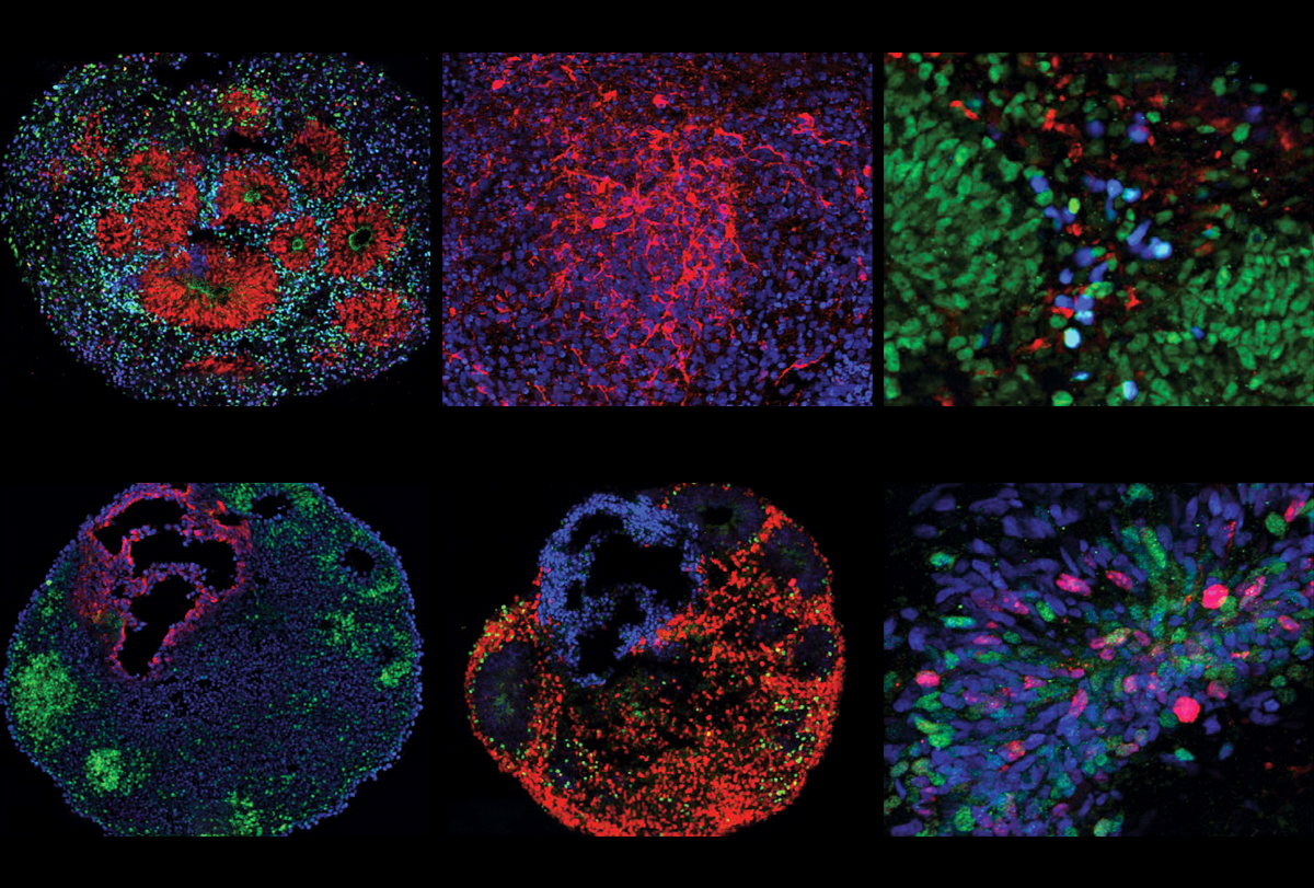 Head size parts autism into two major subtypes | Spectrum | Autism Research News