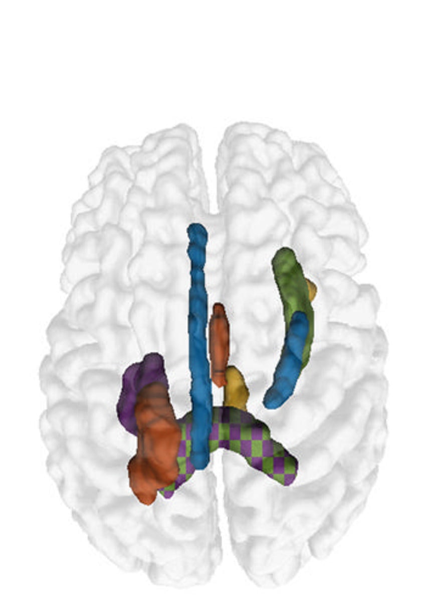 Morphological markers culled from MRI exams help diagnose autism